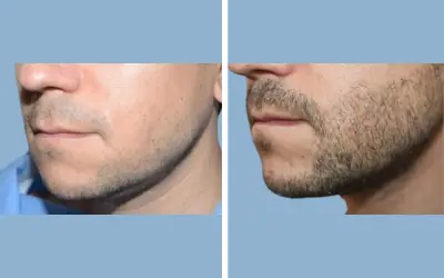Before and After